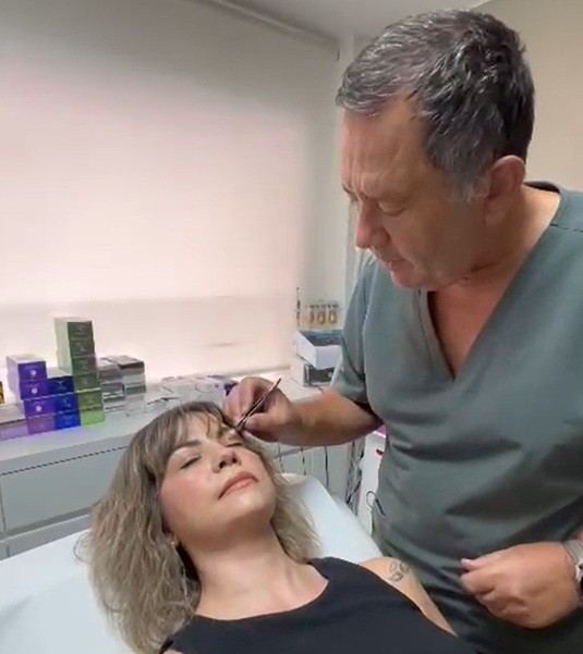 Evolución a los 2 meses de la blefaroplastia: mirada despejada, rejuvenecida y natural. El resultado sigue asentándose en los meses posteriores.
