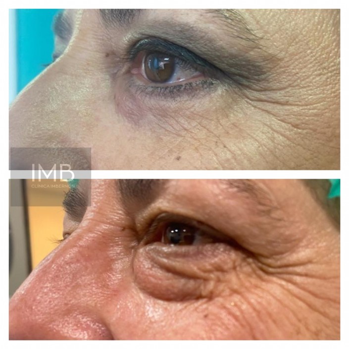 Blefaroplastia inferior y superior. La bolsa de grasa bajo el ojo, que marcaba una sombra permanente de cansancio, se ha reducido con una transición suave entre párpado y mejilla.