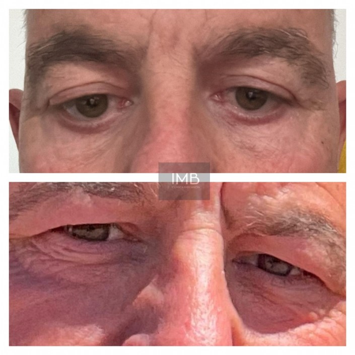 Blefaroplastia inferior y superior. Se ha reducido la expresión de cansancio con una transición suave entre párpado y mejilla.
