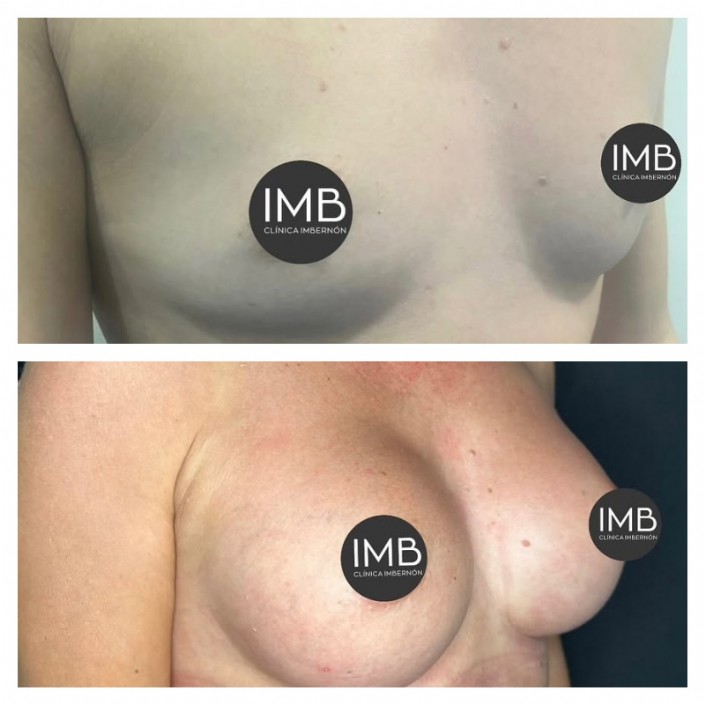 antes y despues del aumento de pecho realizado por el Dr. Imbernón en MURCIA