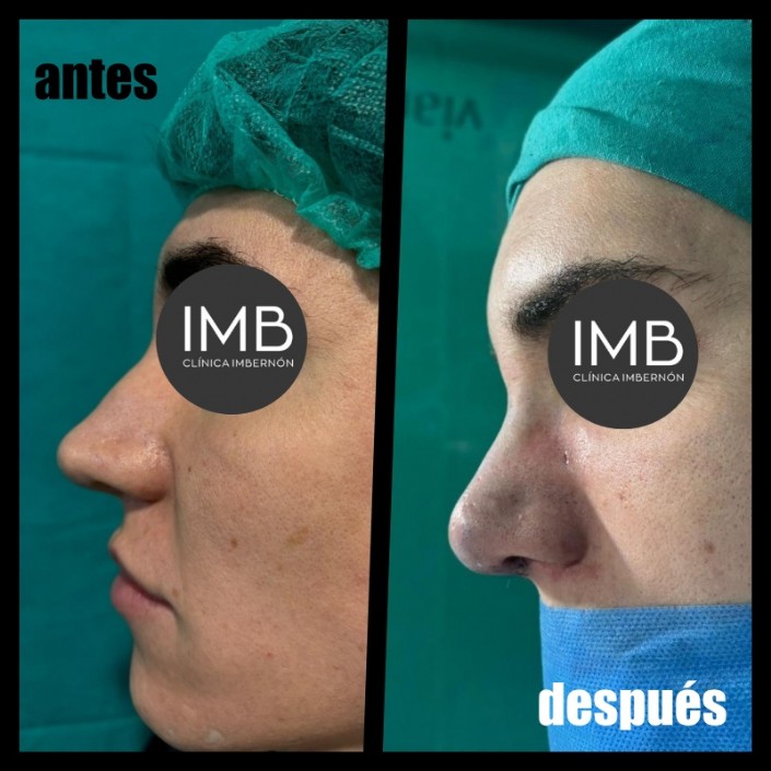 antes-despues-rinoplastia-ultrasonica-murcia.jpg