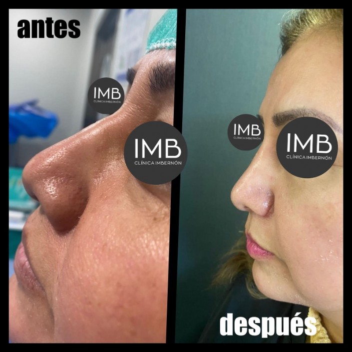 antes-despues-rinoplastia-perfil-estetica-funcional-murcia.jpg