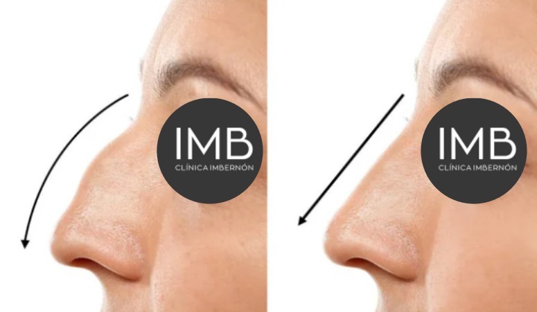 Resultados de rinoplastia: comparación