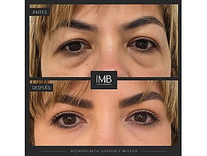 Blefaroplastia en Murcia: cómo rejuvenecer tu mirada con resultados naturales y armónicos