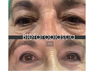 Blefaroplastia en Murcia: resultados reales, antes y después