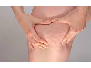lipedema en Murcia, tratamiento en clinica Dr. Imbernón, liposucción especializada.
