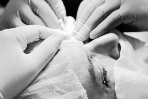 Blefaroplastia Blefaroplastia