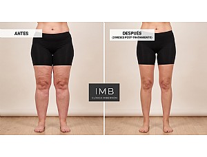 Lipedema en Murcia: síntomas, diagnóstico y opciones de tratamiento